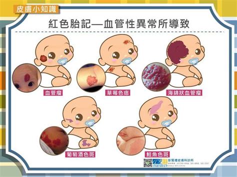 後背有胎記|寶寶胎記長在了什麼部位？不同胎記代表不同命運